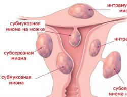 Методы лечения миомы матки без операции