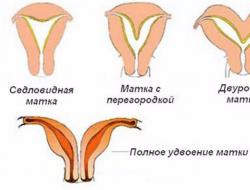 Особенности беременности при седловидной матке