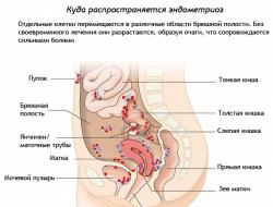 Симптомы эндометриоза у женщин