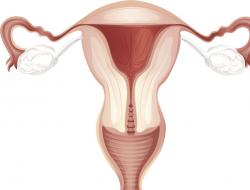 Kuidas ja millega endometrioosi ravida?