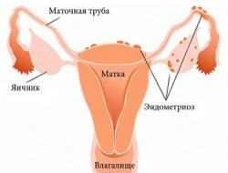 गर्भाशयाच्या एंडोमेट्रिओसिस: लक्षणे आणि उपचार
