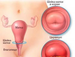 여성의 자궁경부염 - 자궁경부의 염증