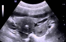 Патологични процеси в шийката на матката