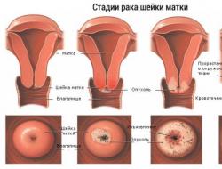 Come si manifesta il cancro della cervice nelle donne?