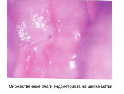 Симптоми та лікування ендометріозу шийки матки