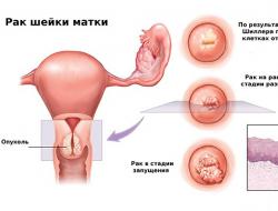 Gebärmutterhalskrebs: Wie sich die Pathologie manifestiert, Methoden zur Prävention und Behandlung, Überlebensprognose