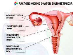 Симптоми ендометріозу сечового міхура