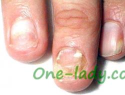 Nail diseases: types, treatment and prevention