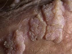 Πώς εκδηλώνεται ο HPV τύπου 16 στις γυναίκες και πώς αντιμετωπίζεται;