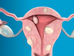 Kuidas ravida emaka fibroidid ilma operatsioonita