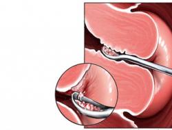 Raschiamento uterino per fibromi