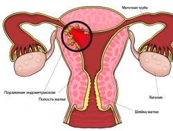 Endometrioos - mis see on, sümptomid ja ravi, tunnused, põhjused, diagnoos